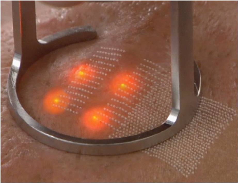 Công Nghệ Laser Fractional CO2 là gì ?